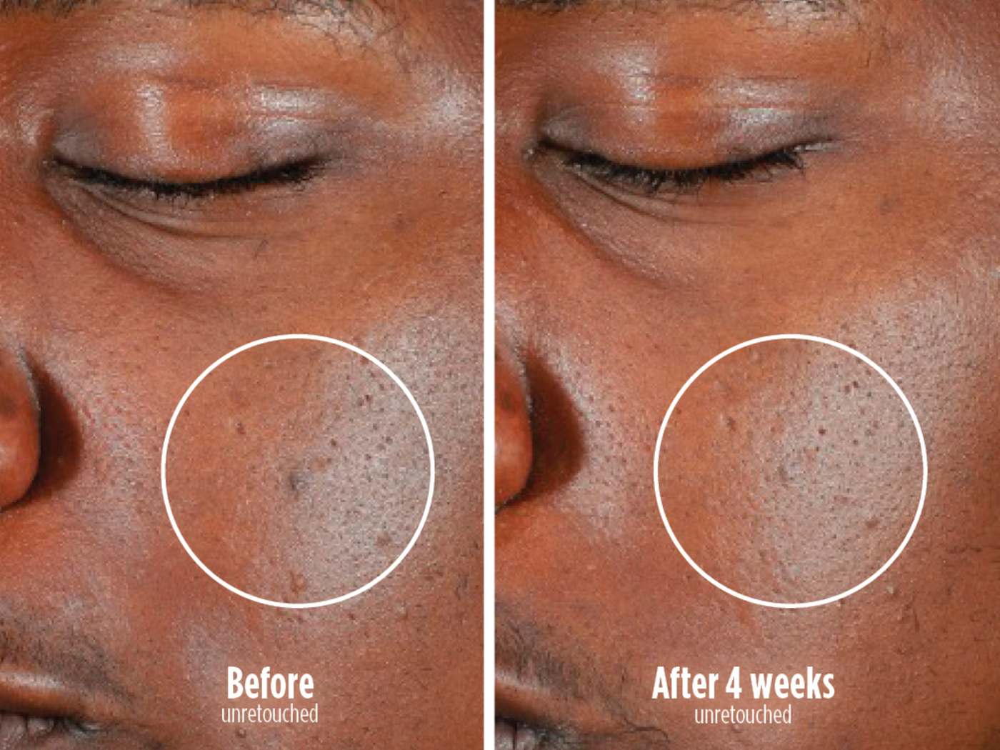 Before and after 4 weeks - skin clearing